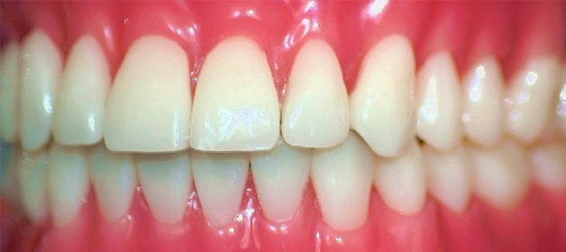 Zahnspange hinter den Zähnen