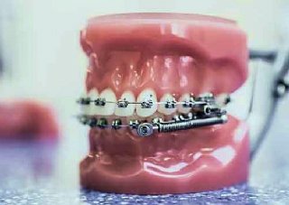 Zahnspangen