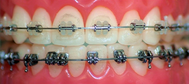 schonende Zahnregulierung