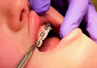 schiefe Zähne Unterkiefer