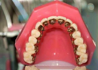 Innere Zahnspange